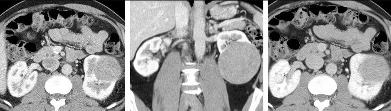 Corticomedullary phase CT in axial and coronal plane, and parenchymal phase, of renal cell carcinoma. For context, see en:Computed tomography of the abdomen and pelvis .