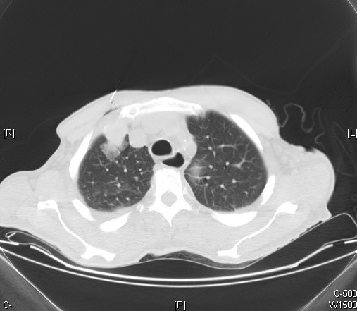 Metastatic renal cell carcinoma - CT scan - Case 262